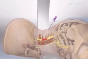 Health in Focus: Epidural Steroid Injections