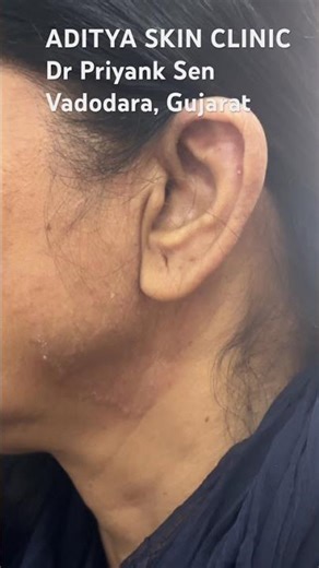 Fungal infection on face | Causes & Treatment by Dermatologist | Dr Sen