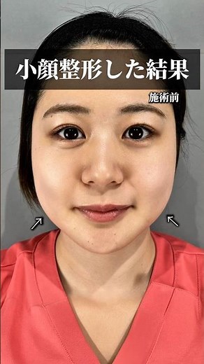 [Buccal Fat] Say goodbye to chubby cheeks! #shorts
