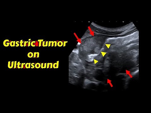 Gastric tumor | Ultrasound Case