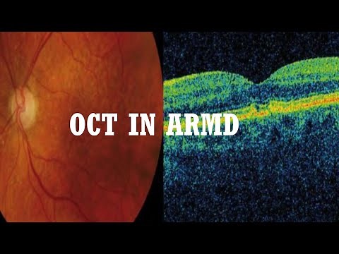 OCT in AMD( Age related macular degeneration