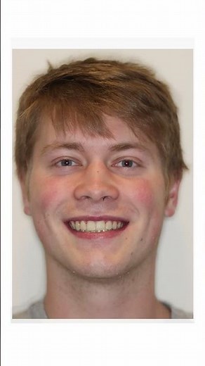Overbite and Crowding Braces Transformation