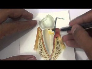 Stages of Gum / Gingival Inflammation - Gingivitis and Periodontitis Stages