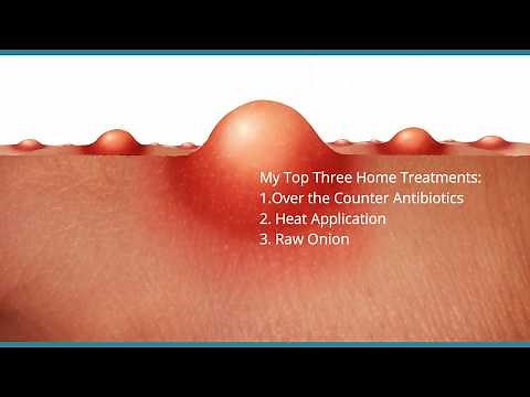 Best Boil Treatment: 3 Home Remedies To Treat Boils Fast