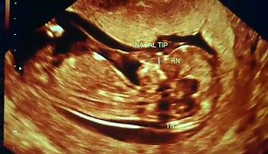 A nuestras FUTURAS MAMAS Embarazadas con Alto riesgo, bajo riesgo y EDAD MAYOR A 35 AÑOS, les presentamos un video de un estudio de 11 a 14 semanas, realizado por el Dr. Edgar Flores. Porque es importante? 1. Calculamos el Riesgo de probabilidad de que tu bebe presente SINDROME DE DOWN 2. Calculamos la probabilidad de que una mama presente PREECLAMPSIA TEMPRANA antes de la semana 34 3. Es el ESTUDIO Especial y obligado MAS IMPORTANTE DURANTE TODO TU EMBARAZO. Debe ser realizado por un medico Gin