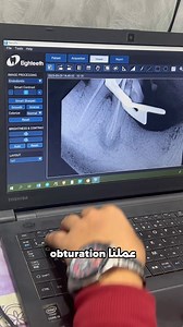 Case No:1 Thank you prof Waleed Kurdi Endodontics Your irrigation protocol 🤍 https://www.tiktok.com/@ali_elmaghraby811?_r=1&_t=ZS-92IbPAY8Hgu https://www.instagram.com/ali_elmghraby?igsh=ZHE2ZTlxb2NqcWUw&utm_source=qr | Ali Hamdy