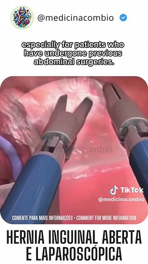 Inguinal Hernia Surgery: Open vs. Laparoscopy Explained