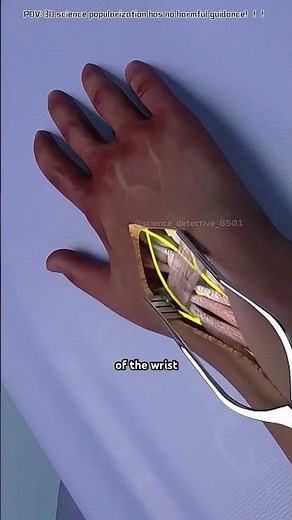 Four Corner Fusion Surgery | Wrist Arthritis Treatment (3D Animation)#wristsurgery #wristarthritis
