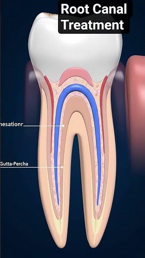 Root Canal Treatment 3D animation of Endodontic Treatment Explained Dental Procedure #endodontic