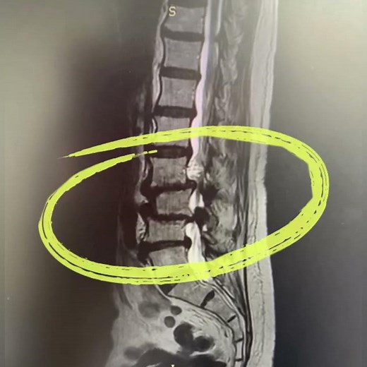 Cirugía de Columna Lumbar