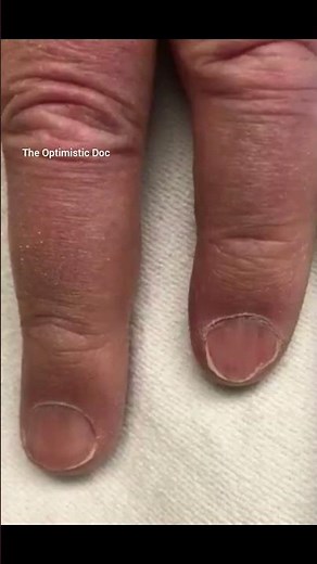 Understanding Quincke's Sign in Aortic Regurgitation (AR): Causes, Symptoms and Treatment 📚 🩺