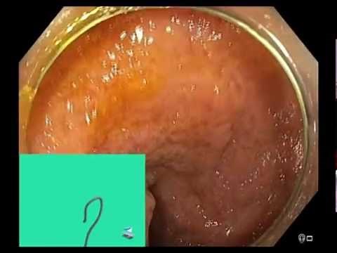 Colonoscopy with ScopeGuide UPD 3