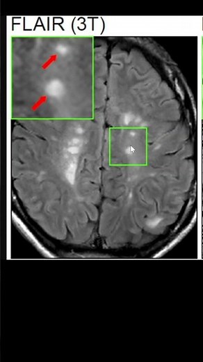Multicenter Double Blinded RCT on Vit D in Multiple Sclerosis