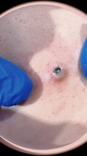 Auspressen einer großen Pickel oder Zyste #Akne #Mitesser #Aknederm #Aknebehandlung