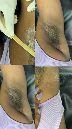 Before vs After… the difference is clear ✨ Underarm waxing at Pretty Faces. 📍 Shop 28B, Portmore Mall 📞 506-8305 #UnderarmWaxing #GlowUpJA #SmoothSkinJA #PrettyFacesSpa #PortmoreMall