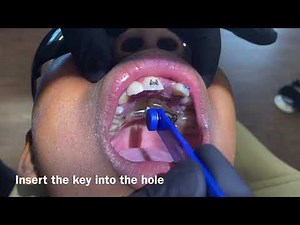 How to turn an expander