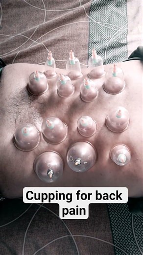cup therapy for back pain.. #anatomy #physiotherapist #hospital #doctor #nurse