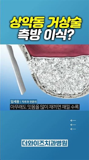 상악동 이식하고 죽다 살아났다?