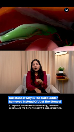 🚨 Why Do Doctors Remove The Entire Gallbladder Instead Of Just The Stones? 🩺🤔