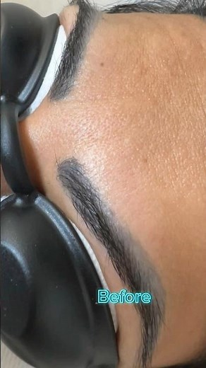 Laser eyebrows removal