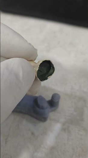 CAD/CAM dental crowns (Computer-Aided Design/Computer-Aided Manufacturing) #cadcam #cadprinting