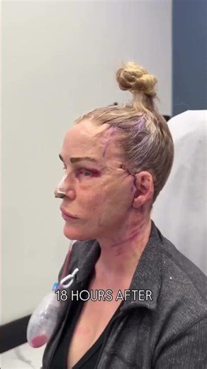 18 Hours After a Deep Plane Facelift #deepplanefacelift #faceliftrecovery