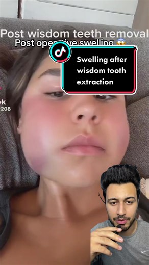 Post operative swelling after 3rd molar extraction | #dentist #dental #foryou #learnontiktok #fitdentistofficial #healthadvice