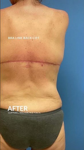 Bra Line Back Lift #backliftsurgery #backlift #looseskin