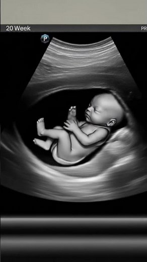 20 Weeks Ultrasound Scan | It's Time to Reveal Fetus Gender