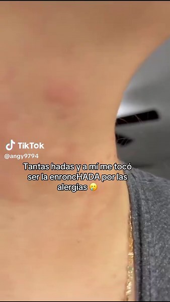 Alergias: Cómo lidiar con los efectos visibles