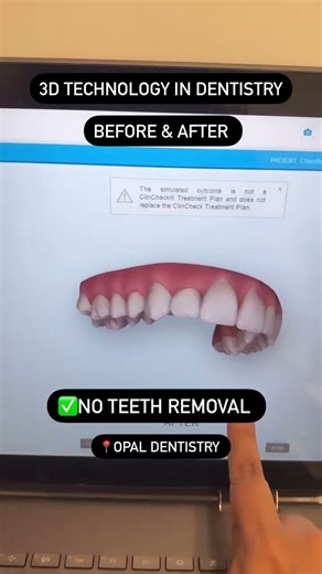 3D technology used to create custom, clear aligners for teeth straightening.