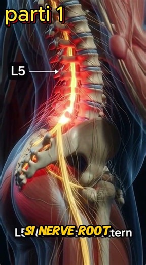 Mapping Sciatica Pain