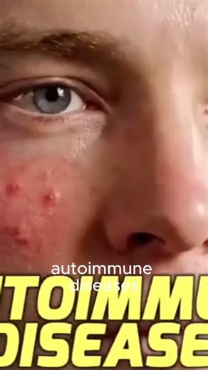 The Immune Balance That Fights Autoimmune Dis #drericberg #healthyketo