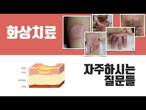화상치료 FAQ 1탄_화상응급처치 & 1도, 2도(표재성/심재성), 3도 화상의 구분