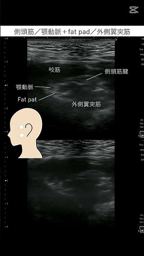 【エコー映像】側頭筋／顎動脈＋fat pad／外側翼突筋​