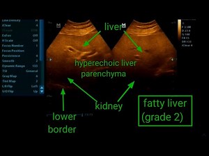 Fatty liver (grade 2) || ultrasound