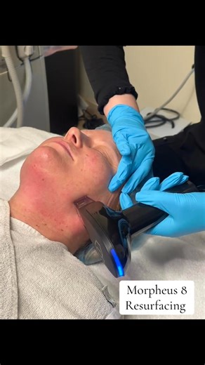✨ Transform your skin from the inside out with Morpheus8 RF Microneedling — one of the most advanced skin rejuvenation treatments available at Paragon Plastic Surgery & Med Spa. ✨ Morpheus8 combines microneedling with radiofrequency (RF) energy to remodel collagen and elastin deep within your skin — creating smoother, tighter, and more radiant results that continue to improve over time. 🌟 Here’s how it works: 🔹 Microneedling creates tiny micro-injuries that stimulate your body’s natural healin