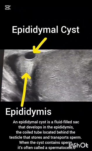 Scrotal ultrasound showing epididymal cyst #ultrasoundmadeeasy86 #radiology #viralshort