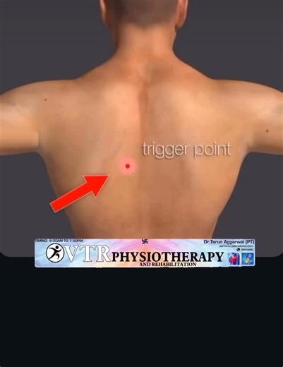 Dr Tarun Aggarwal on Instagram: "Trigger Points – the hidden cause of your pain ❗ That deep, nagging pain you feel may not be coming from joints or nerves — it could be trigger points (muscle knots). ✔ Causes referred pain ✔ Reduces mobility ✔ Creates muscle weakness 💆‍♂️ Trigger point therapy helps release tight muscles, restore movement & reduce pain naturally. 📍Book your session at VTR Physiotherapy & Rehabilitation #physiotherapy #triggerpoint #muscleknots #pain"