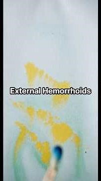 External Hemorrhoids