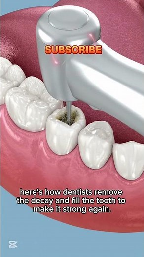 Why Cavities DESTROY Your Teeth | 3D Dental Animation