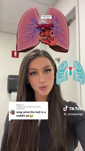 Understanding Saddle Pulmonary Embolism - What You Need To Know