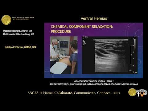 Management of complex ventral hernia repair: Preoperative botulinum toxin A