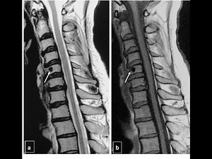 التصوير بالرنين المغناطيسي للعمود الفقري العنقي Cervical Spine MRI