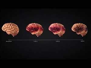 Traumatic Brain Injury Timeline Animation Charts Encephalomalacia