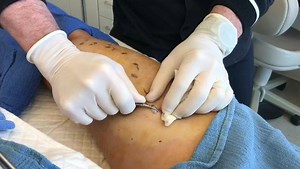 Ambulatory Phlebectomy with Matt Kelleher, MD is an incredibly effective procedure for removing varicose veins. It is performed under local anesthesia in the office. The 2mm incisions heal immediately without sutures or a visible scar. There is typically no bleeding or recovery and patients return to normal activities immediately, except vigorous exercise for one week. 100% vein elimination is achieved in a single treatment without pain, recovery or scars. #varicoseveins #legveins | Premier Derm