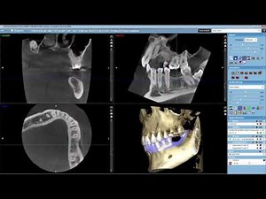 Overlaying an STL File with a CBCT Volume