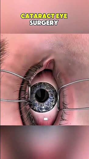 Cataract Eye Surgery |3D ANIMATIONS| CataractSurgery #EyeSurgery #CataractRemoval#fyp