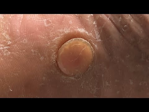 What is this Bump on the Foot?