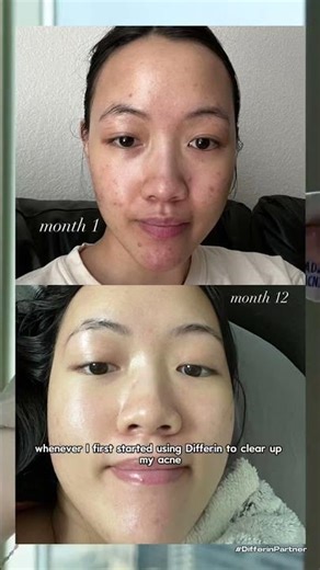 How to Clear Your Acne in 2026 with Differin Gel